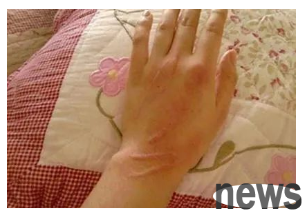Be careful when petting cats! I got this rare disease after being scratched by a pet cat